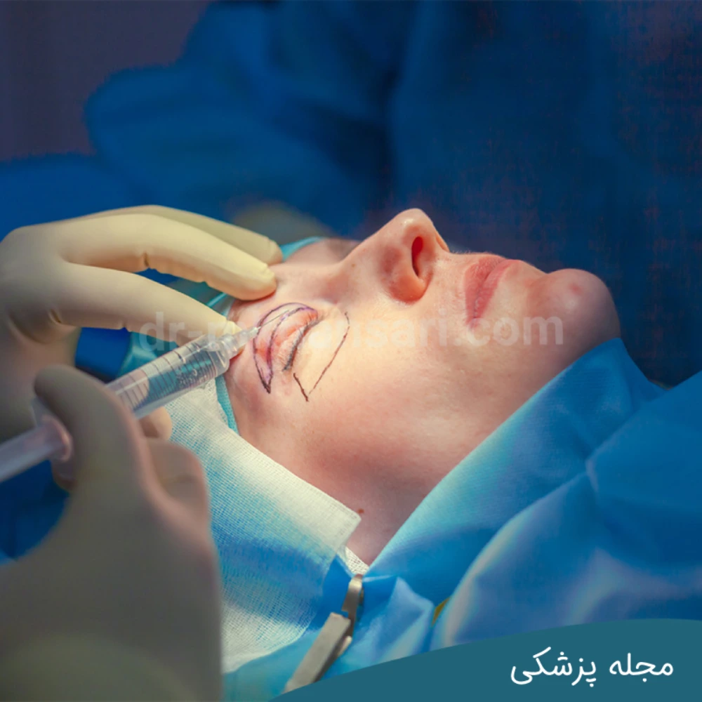 عمل بلفاروپلاستی با بی حسی یا بیهوشیdr-mkhansari