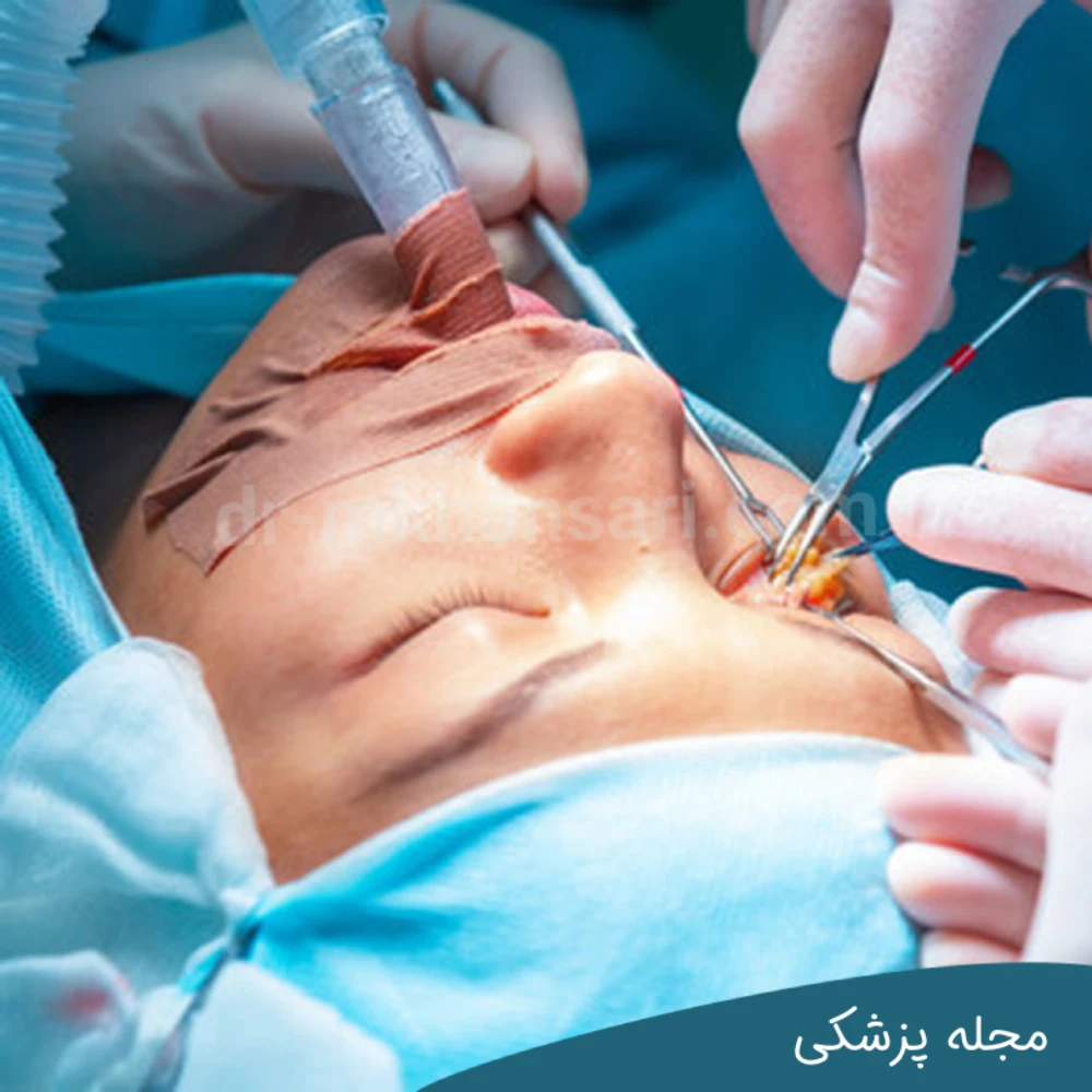 عمل بلفاروپلاستی با بی حسی یا بیهوشی-dr-mkhansari