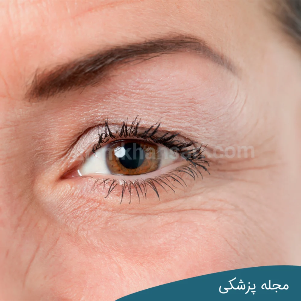 چند روز بعد از عمل بلفاروپلاستی بخیه کشیده می شود؟dr-mkhansari