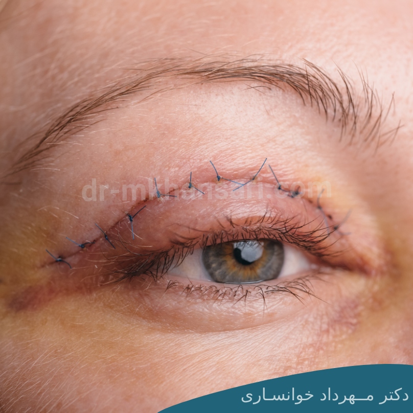 عفونت چشم بعد از جراحی بلفاروپلاستی-dr-mkhansari