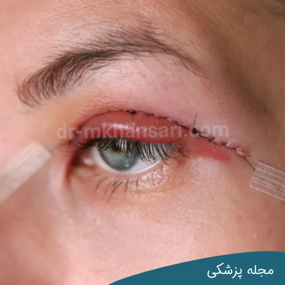 عفونت چشم بعد از جراحی بلفاروپلاستی-dr-mkhansari