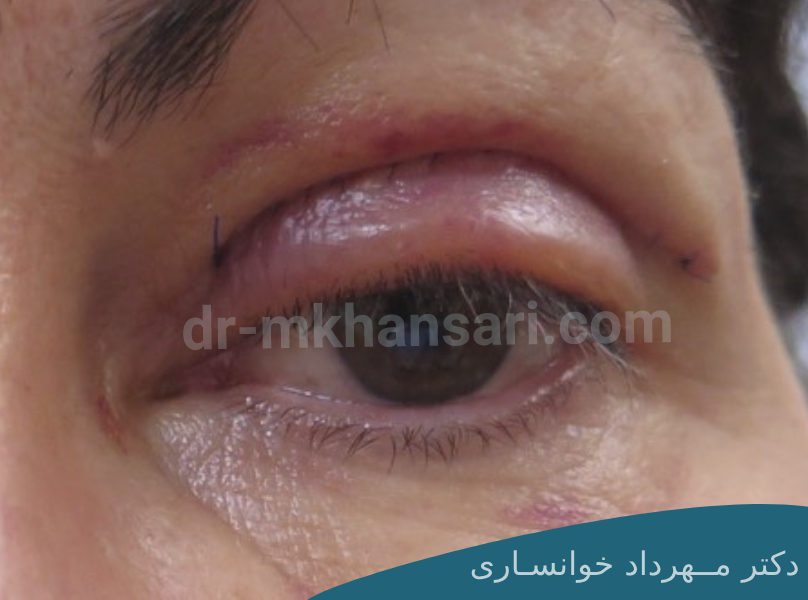 رفع کبودی زیر چشم بعد از عمل بلفاروپلاستیdr-mkhansari