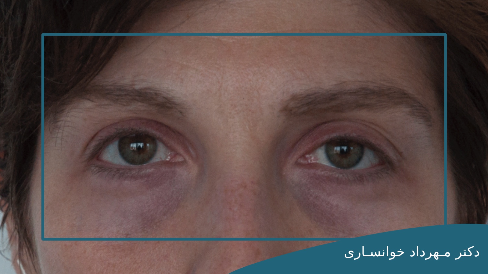رفع کبودی زیر چشم بعد از جراحی بلفاروپلاستی-dr-mkhansari
