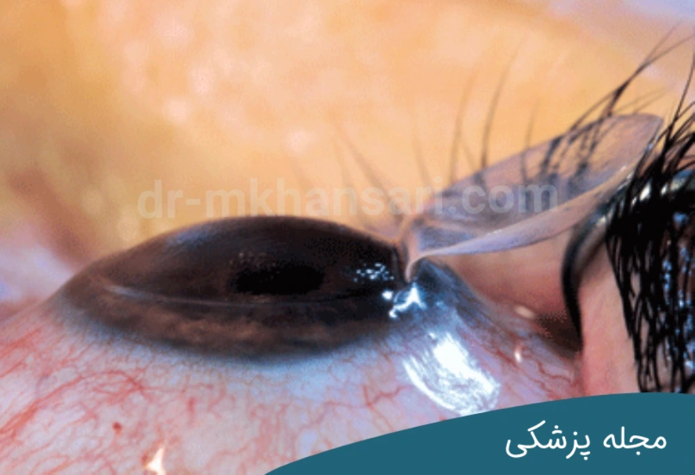 عمل لیزر چشم dr-mkhansari