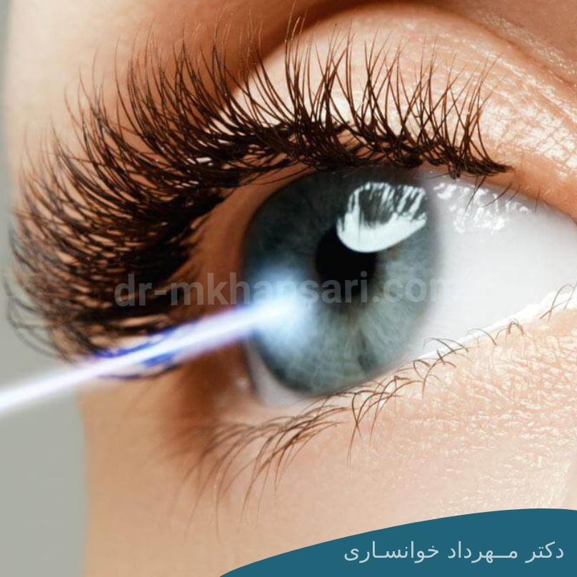عمل لیزر چشم dr-mkhansari