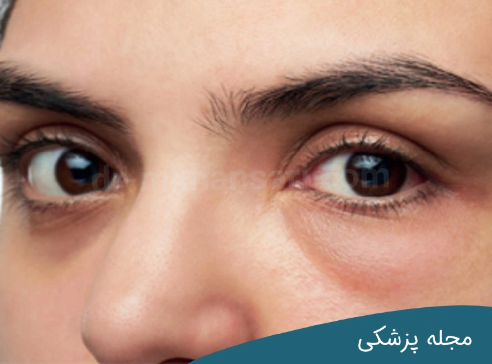 رابطه پف چشم و تیروئید - dr-mkhansari