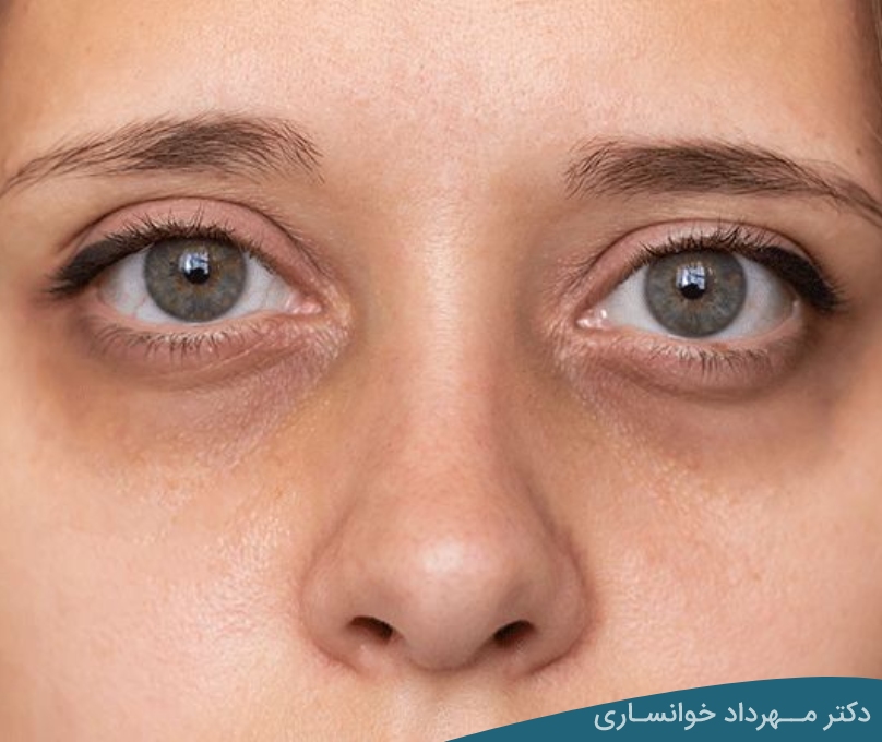 درمان تیرگی زیر چشم - dr-mkhansari