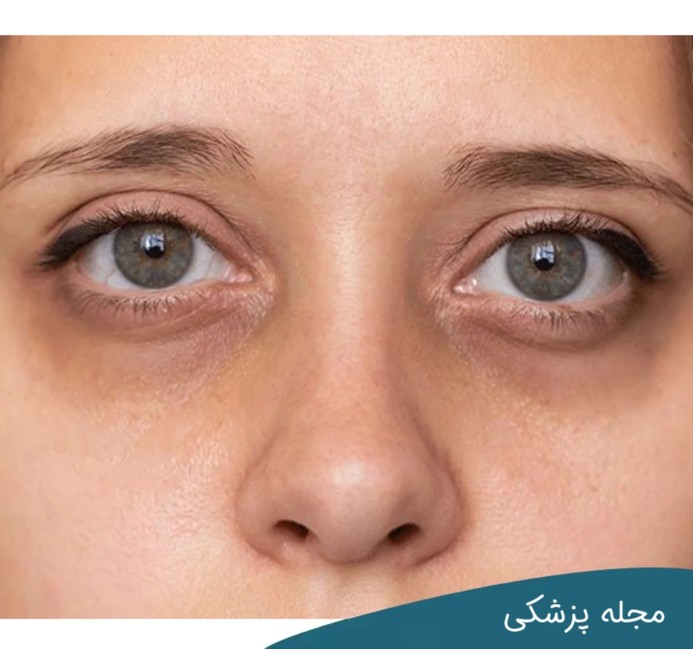 درمان تیرگی زیر چشم - dr-mkhansari