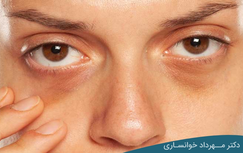 رفع سیاهی دور چشم - dr-mkhansari