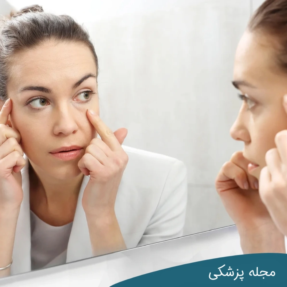پف چشم اول صبح - dr-mkhansari