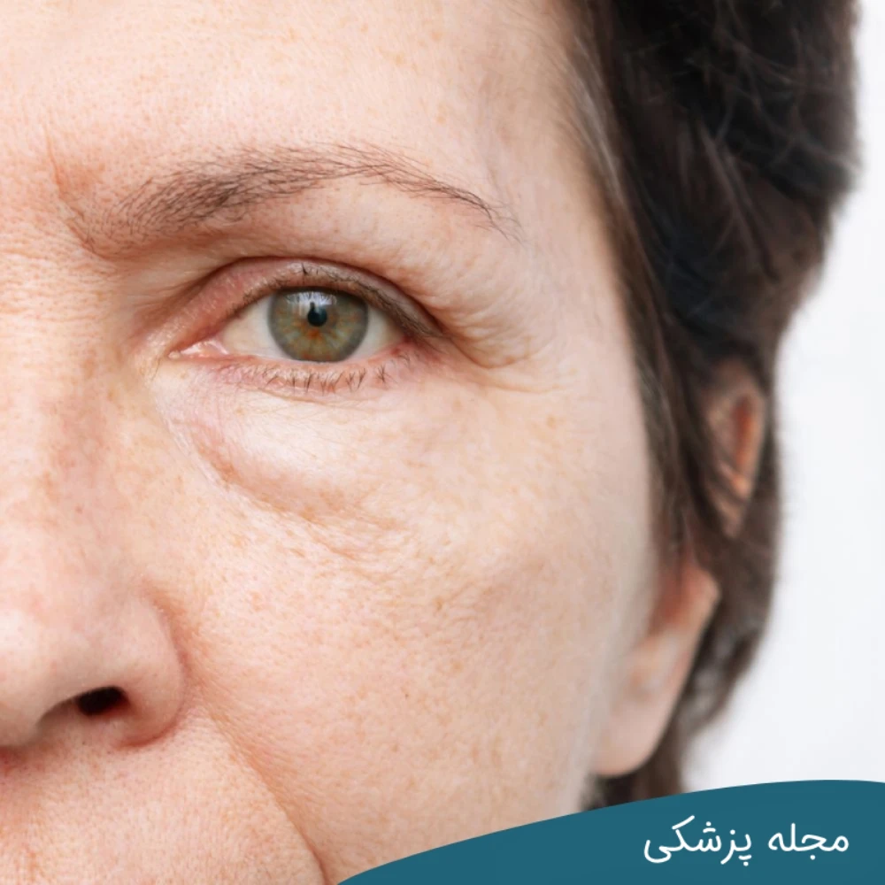 علت پف چشم در صبح - dr-mkhansari