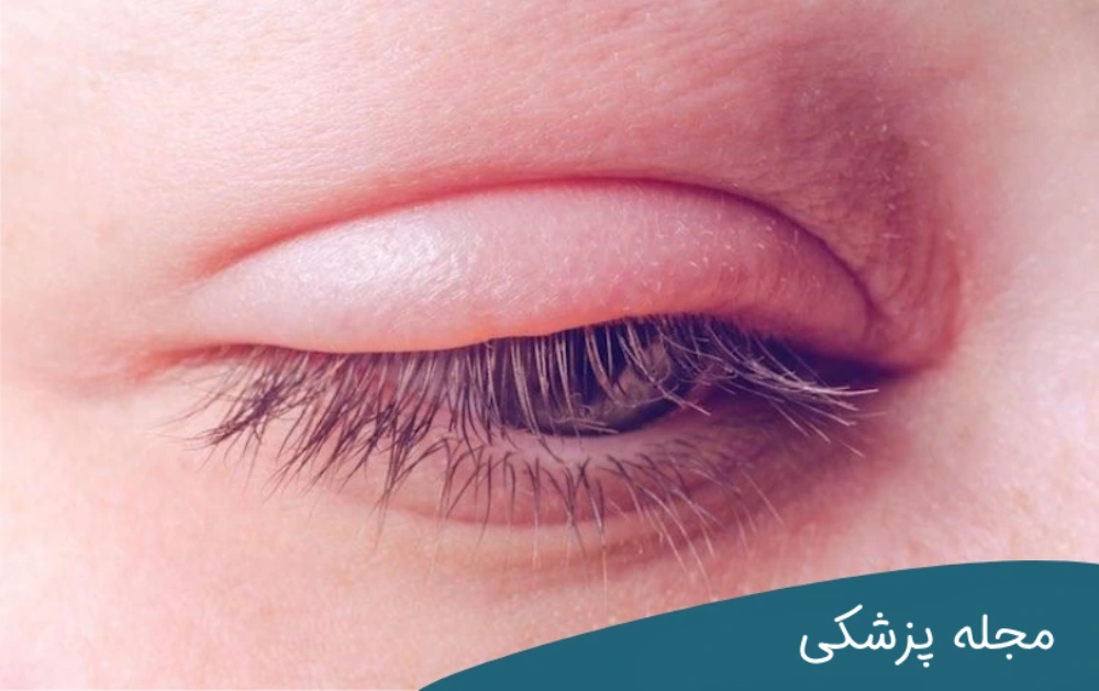 پف چشم بعد از بن مژه - dr-mkhansari