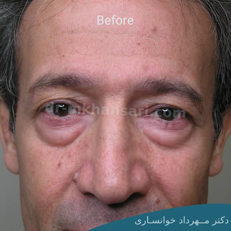 مراقبت های بعد از عمل بلفاروپلاستی-dr-mkhansari.com