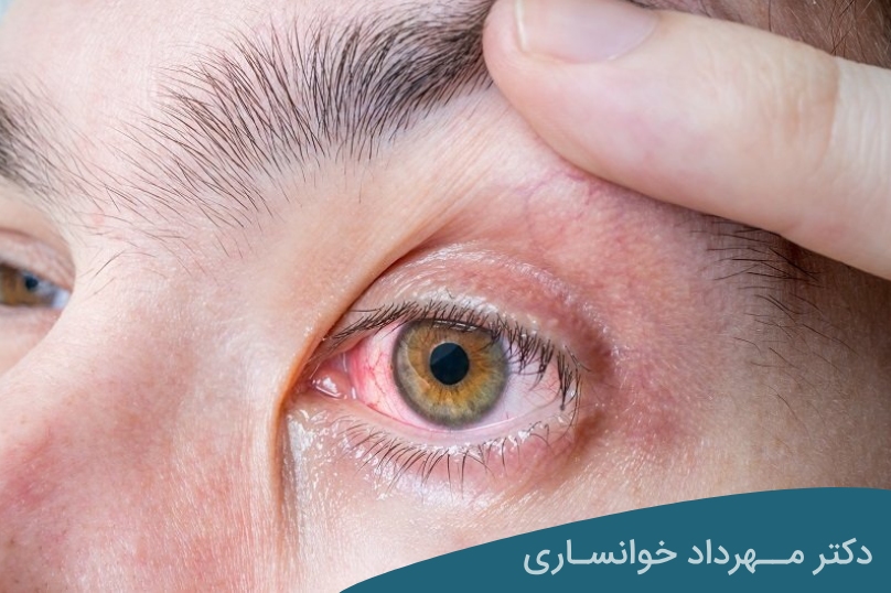 خطرات قرمزی چشم - dr-mkhansari
