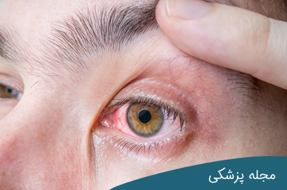 خطرات قرمزی چشم - dr-mkhansari