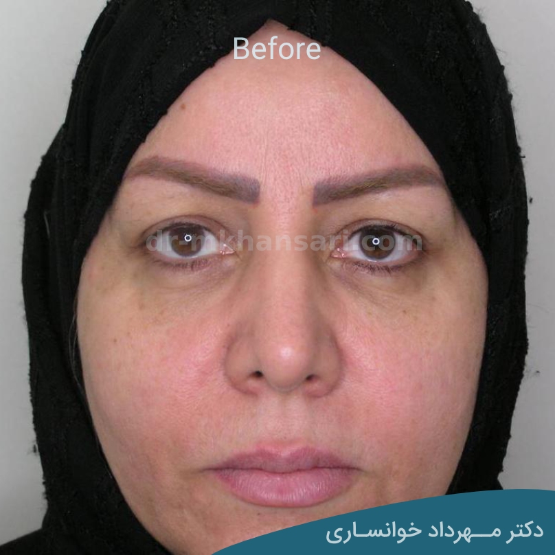جراحی زیبایی چشم - dr-mkhansari