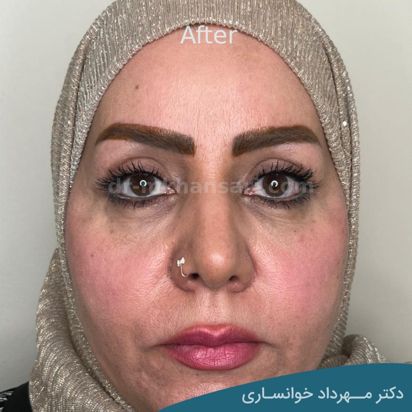 عمل زیبایی پلک افتاده-dr-mkhansari