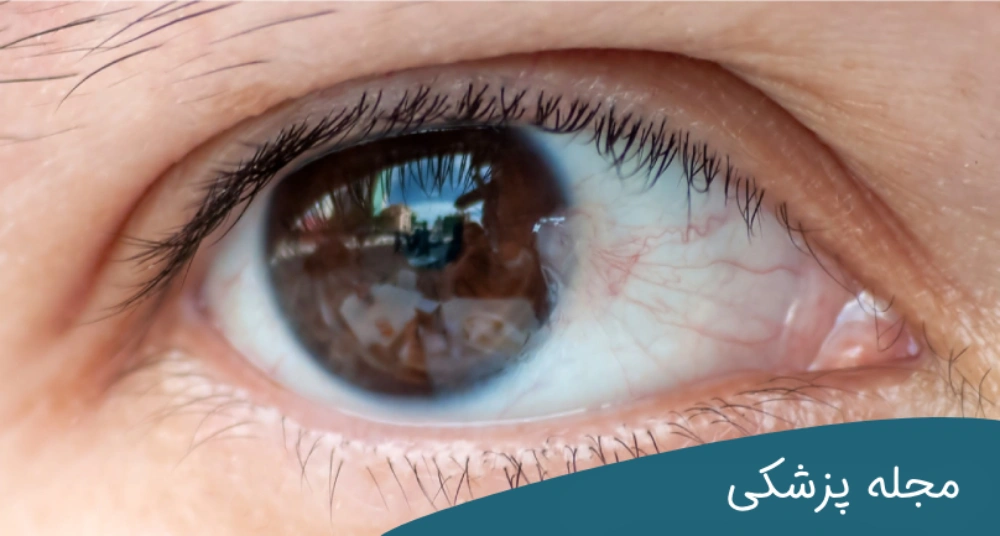 آیا ناخنک چشم از بین می رود؟ - dr-mkhansari