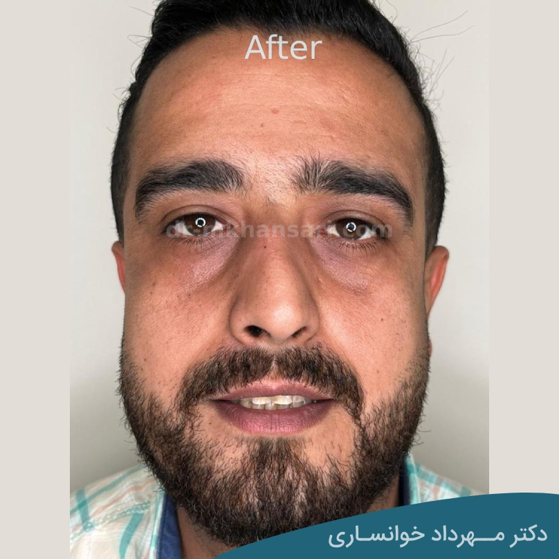 جراحی پلک پایین - dr-mkhansari.com