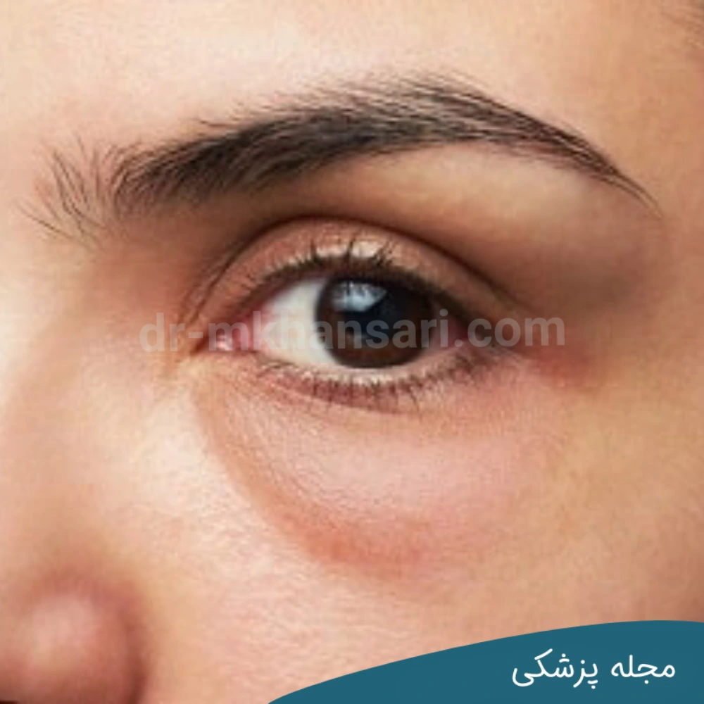 پف چشم بعد از خواب - dr-mkhansari.com