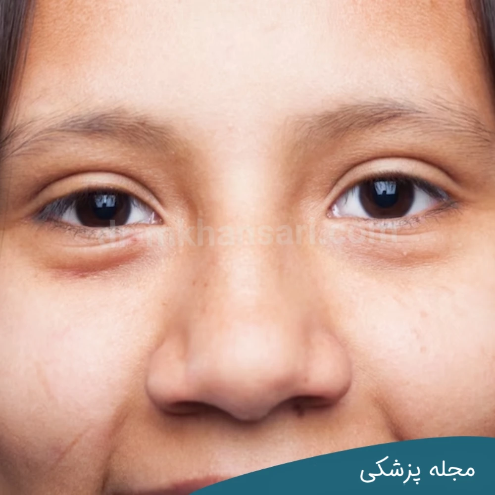 پف چشم بعد از خواب - dr-mkhansari.com