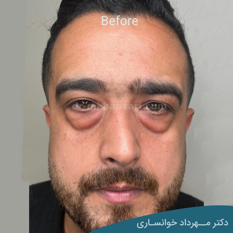 جراحی پلک پایین - dr-mkhansari.com