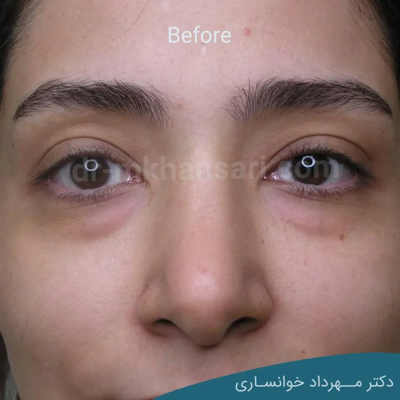 عمل زیبایی پلک افتاده-dr-mkhansari