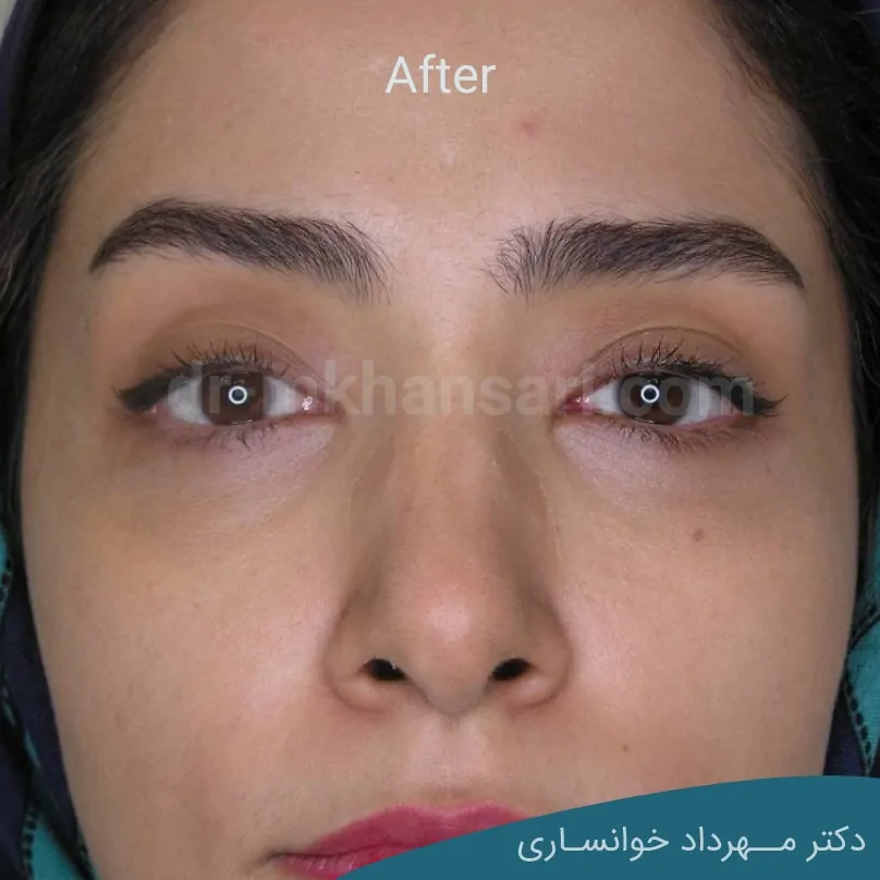 عمل زیبایی پلک افتاده-dr-mkhansari