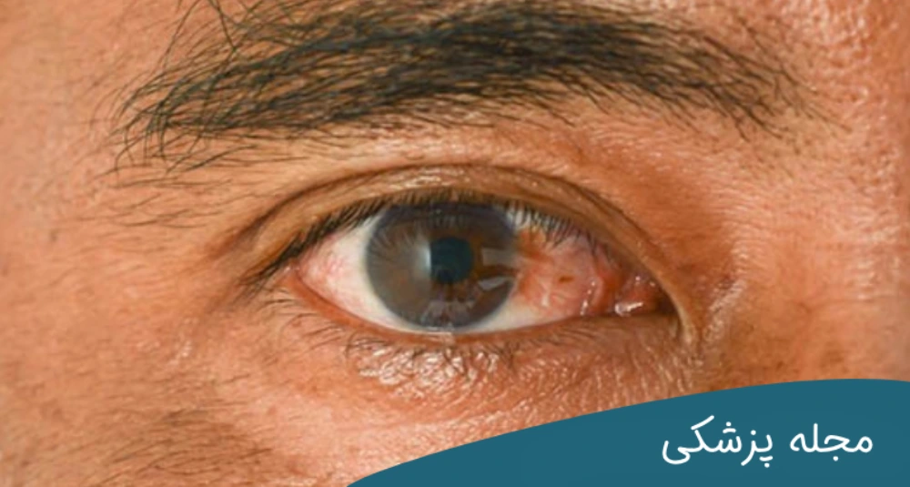 ایا ناخنک چشم از بین میرود؟ - dr-mkhansari