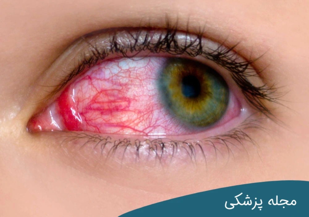 خطرات قرمزی چشم - dr-mkhansari
