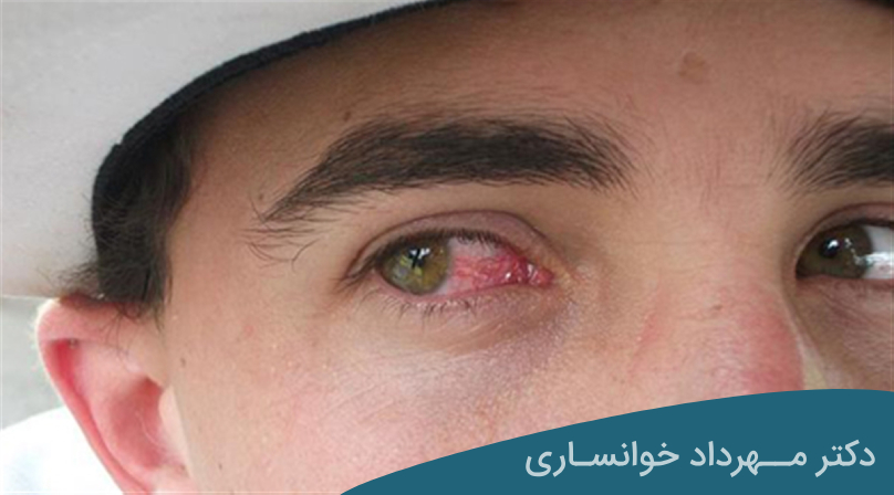 خطرات قرمزی چشم - dr-mkhansari