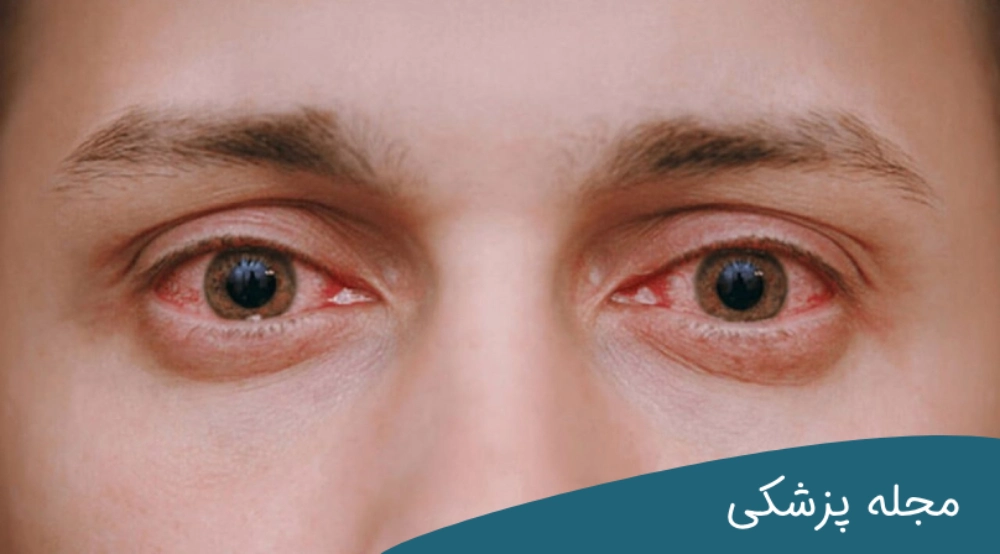 خطرات قرمزی چشم - dr-mkhansari