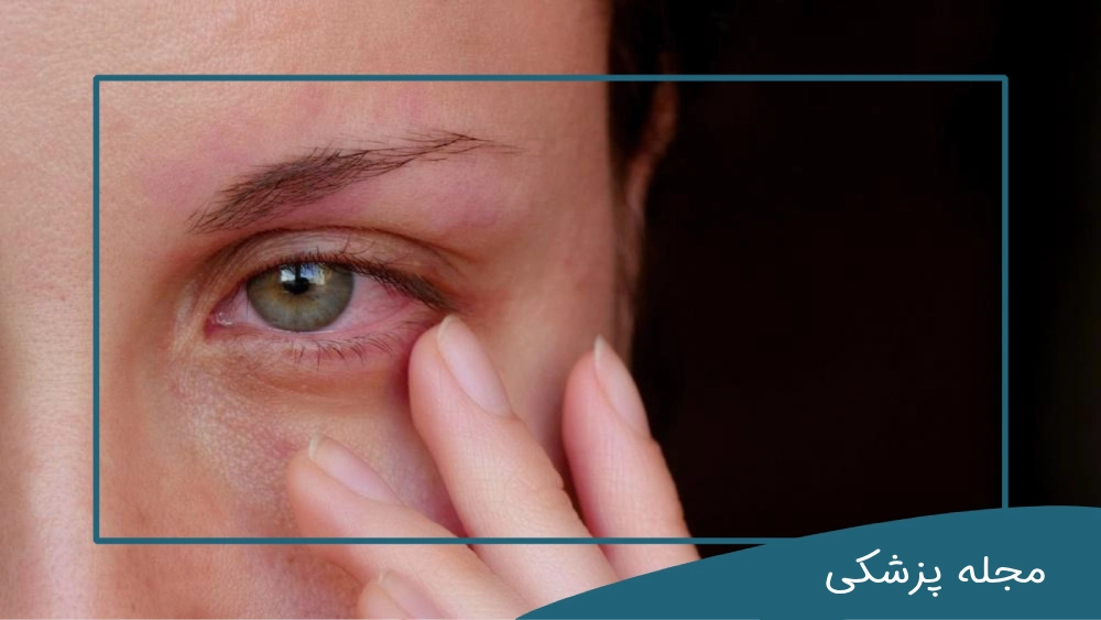 خطرات قرمزی چشم - dr-mkhansari