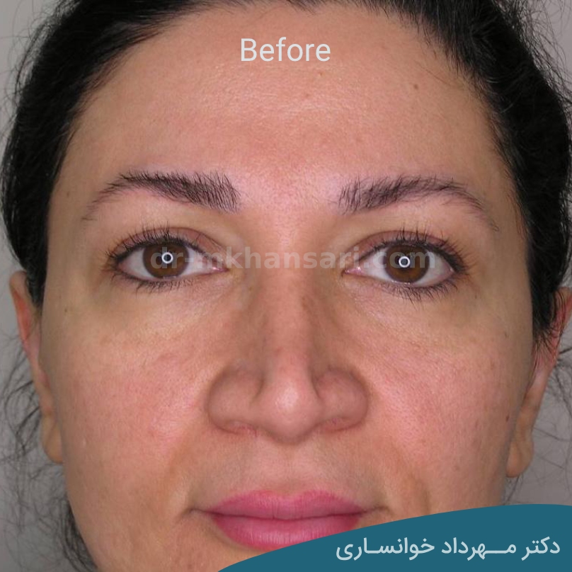 مراقبت های بعد از عمل بلفاروپلاستی- dr-mkhansari.com