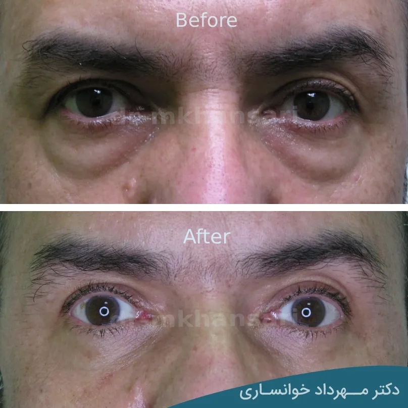 تصاویر عمل پلک چشم - دکتر مهرداد خوانساری