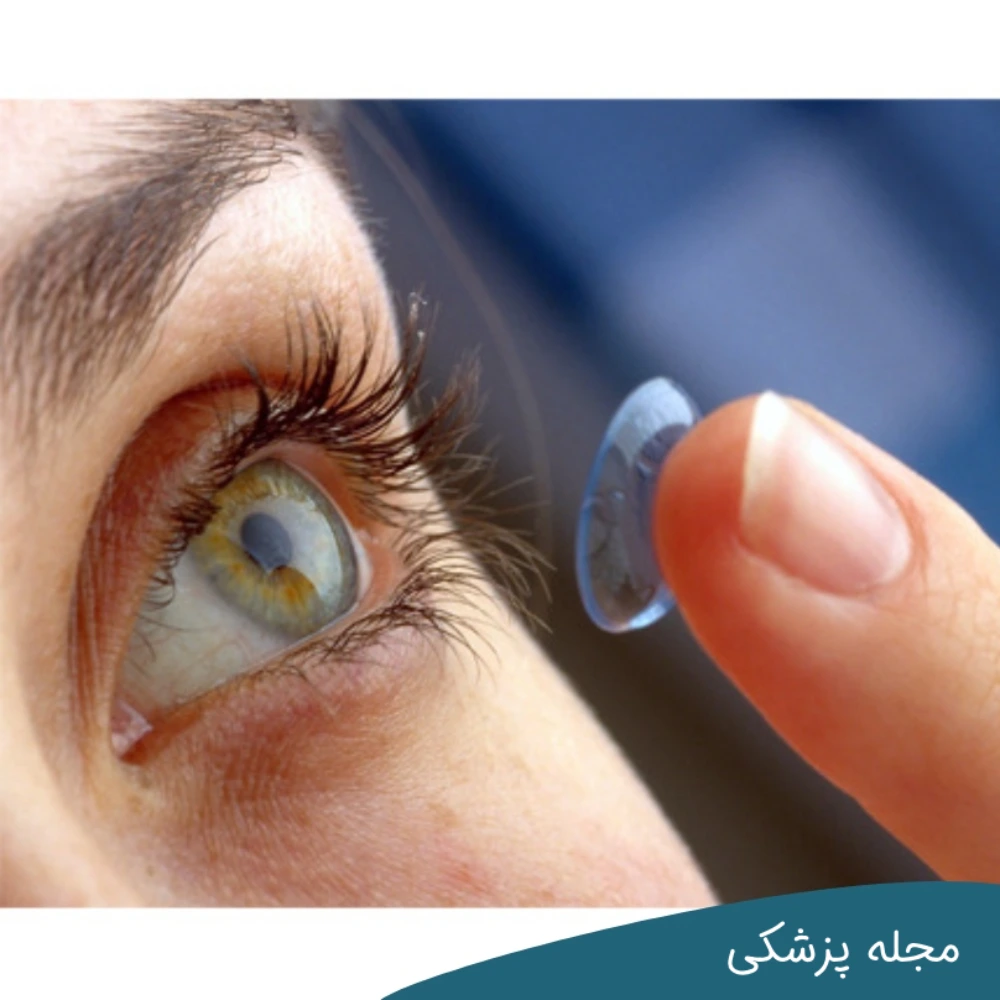 لنز تماسی - dr-mkhansari