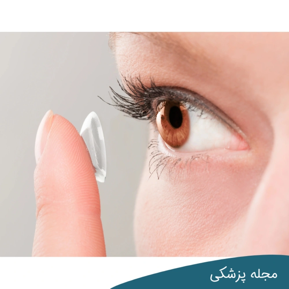 لنز تماسی - dr-mkhansari