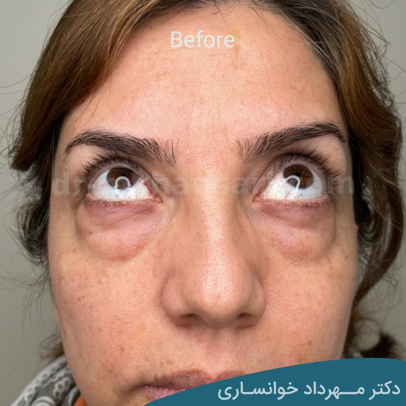 جراحی پلک - dr-mkhansari