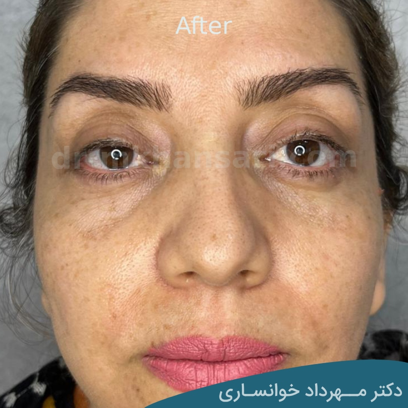 جراحی پلک - dr-mkhansari