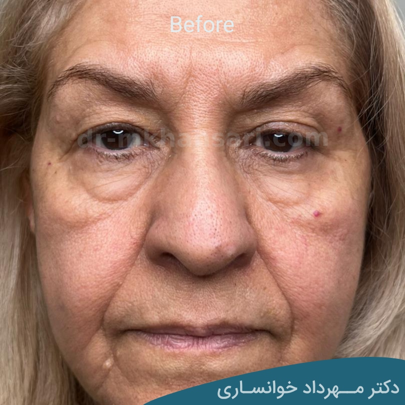 مراحل بهبود بلفاروپلاستی-دکتر خوانساری
