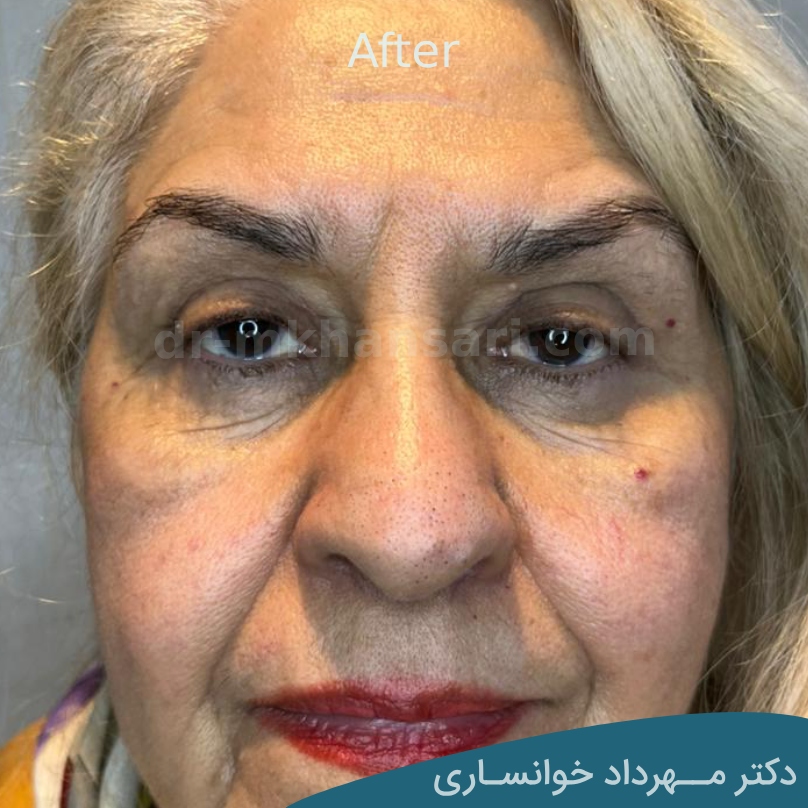 مراحل بهبود بلفاروپلاستی-دکتر خوانساری