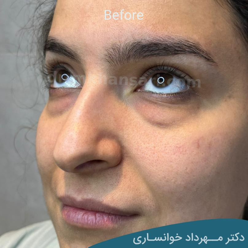 عمل پشت پلک - dr-mkhansari.com