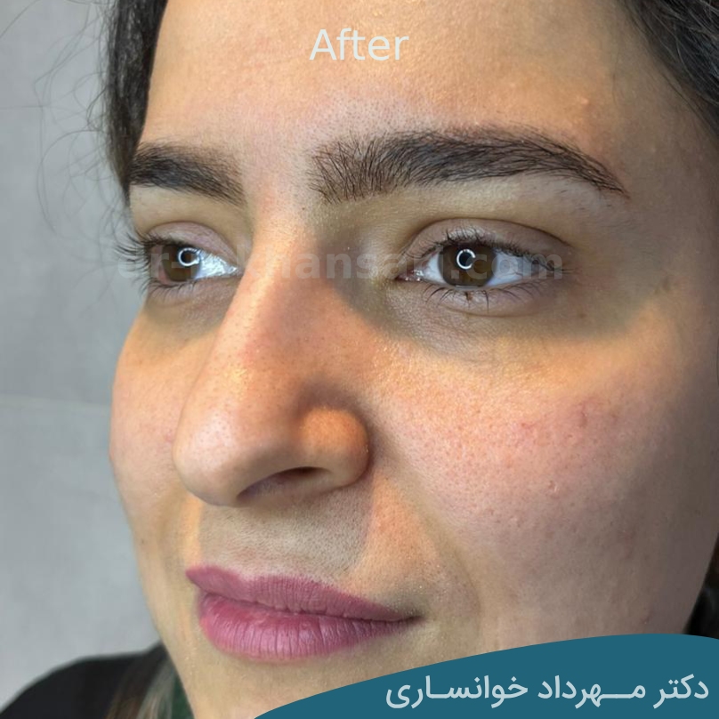 عمل پشت پلک - dr-mkhansari.com