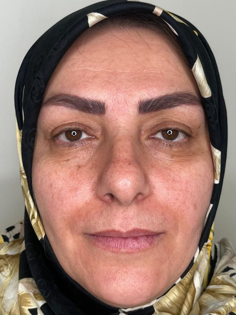 عمل پشت پلک - dr-mkhansari.com