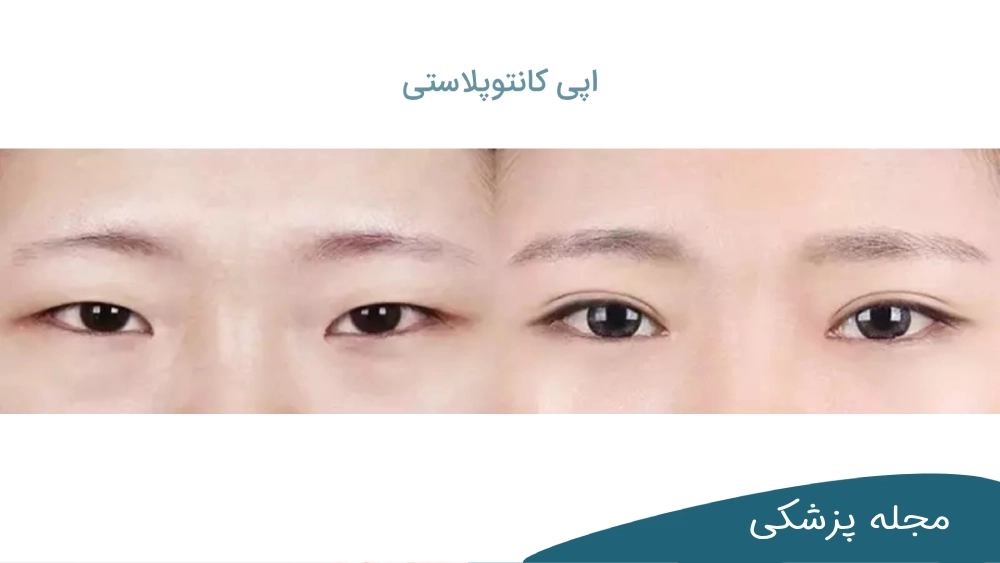 جراحي درشت كردن چشم - دکتر مهرداد خوانساری