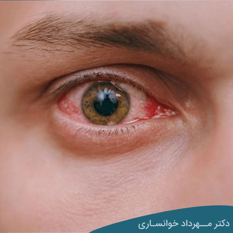 بیماری بهجت چشم - دکتر خوانساری