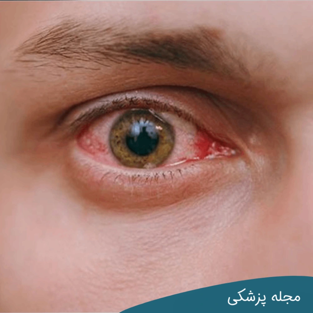 بیماری بهجت چشم - دکتر خوانساری