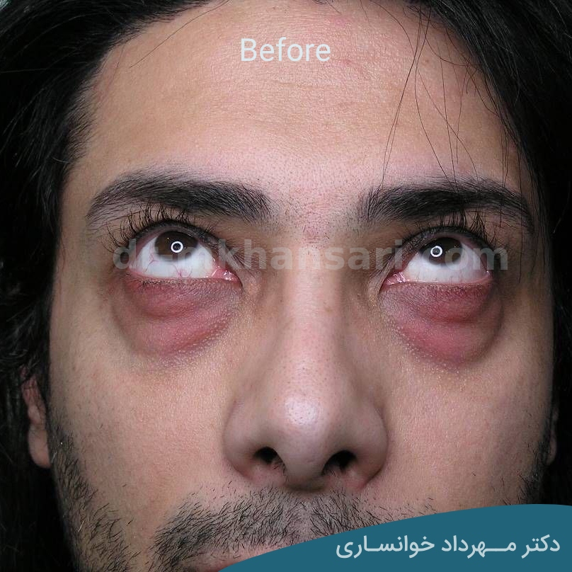 جراحی زیبایی پلک - دکتر خوانساری