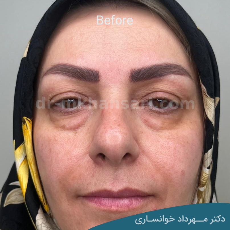 عمل پشت پلک - dr-mkhansari.com