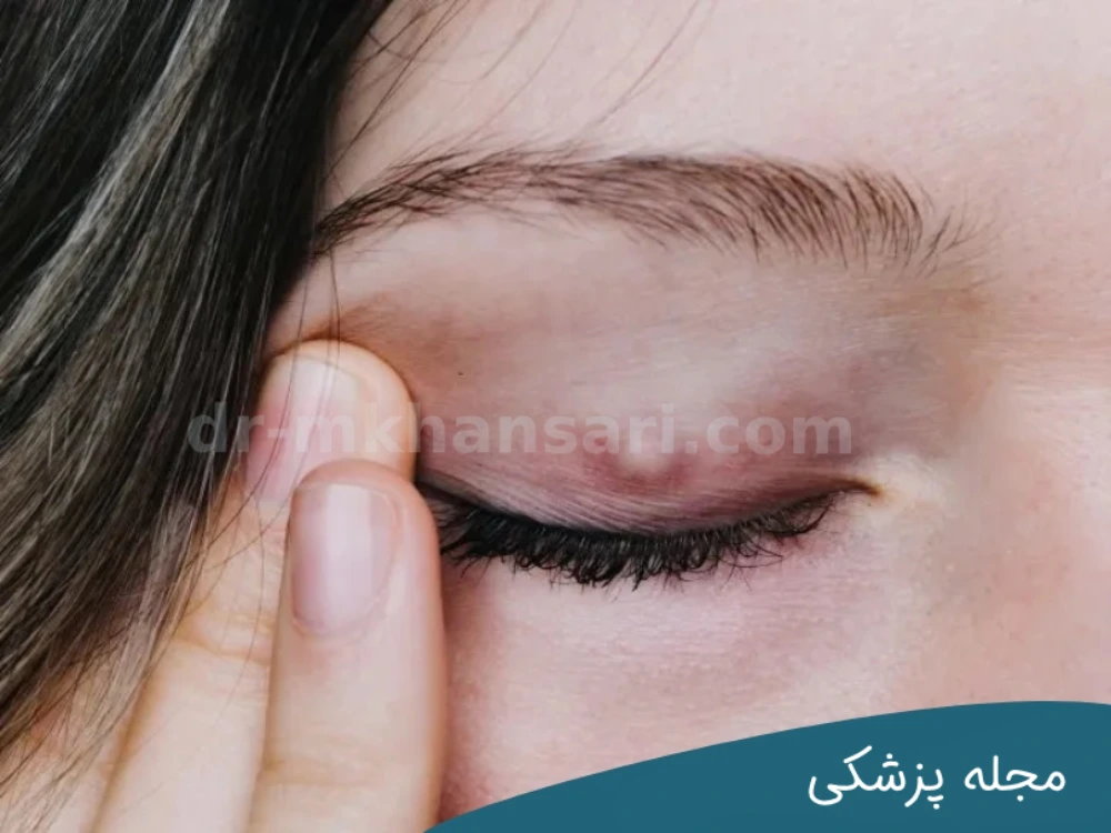 کیست چشم - دکتر خوانساری